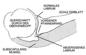 schulter lux01
