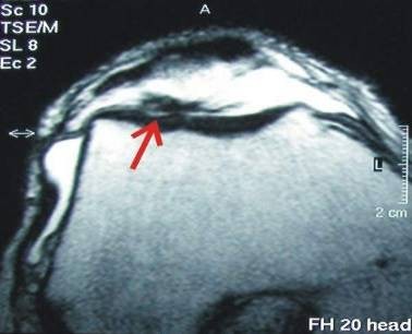 arthrose04