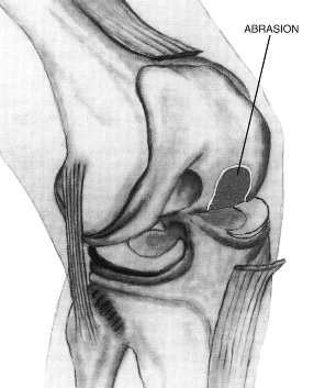 arthrose01