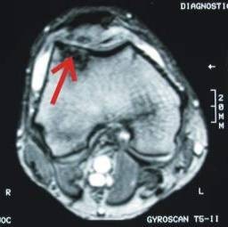 arthrose03